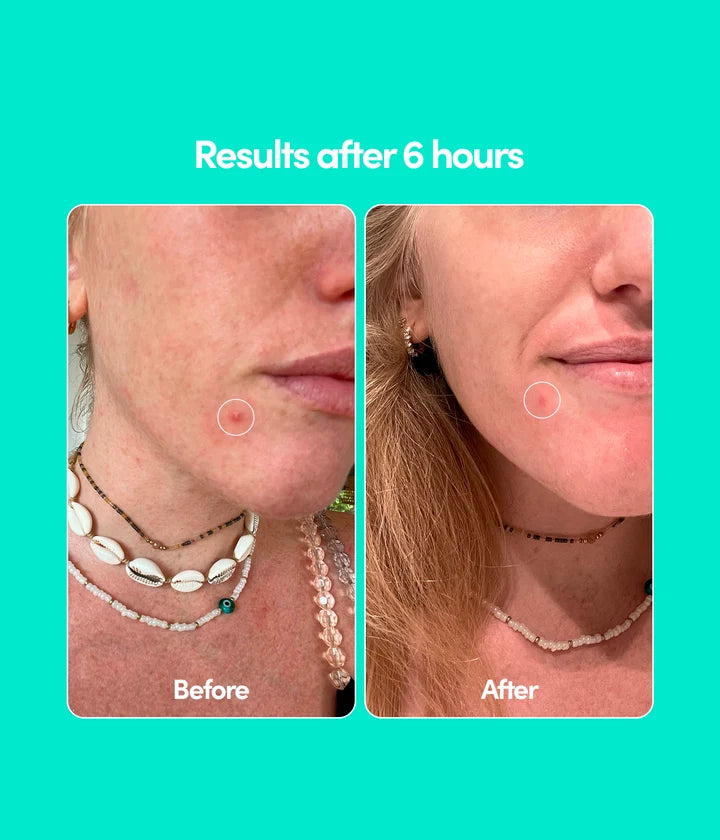 24 Blemish Patches