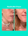 24 Blemish Patches